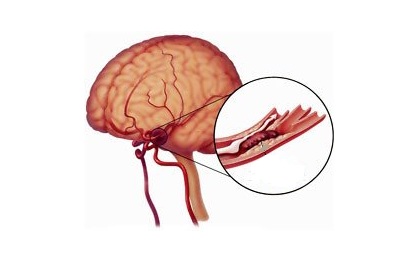 Атеросклероз сосудов головного мозга: симптомы, диагностика, лечение | Клиника доктора Шишонина